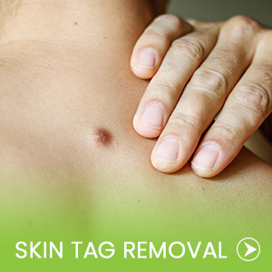 Skin Tag Removal at Manatee Primary Care in Bradenton, FL