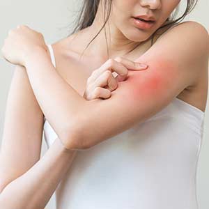 Allergies Treatment in Bradenton, FL