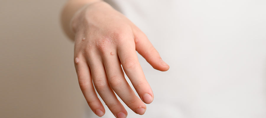 Cryotherapy for Warts and Skin Lesions Near Me in Bradenton, FL