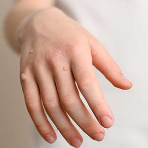 Cryotherapy for Warts and Skin Lesions in Bradenton, FL
