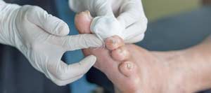 Diabetic Foot Ulcers Treatment Clinic Near Me in Bradenton, FL Diabetic Foot Ulcers Treatment Clinic Near Me in Bradenton, FL