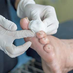 Diabetic Foot Ulcers Treatment in Bradenton, FL