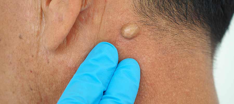 Cyst Incision and Drainage Clinic Near Me in Bradenton, FL Cyst Incision and Drainage Clinic Near Me in Bradenton, FL
