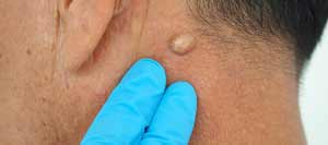 Cyst Incision and Drainage Clinic Near Me in Bradenton, FL Cyst Incision and Drainage Clinic Near Me in Bradenton, FL