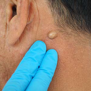 Incision and Drainage of Cysts in Bradenton, FL