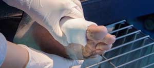 Pressure Ulcers (Bedsores) Treatment Clinic Near Me in Bradenton, FL