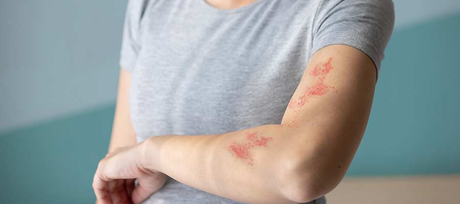 Minor Skin Infections Treatment Clinic Near Me in Bradenton, FL Minor Skin Infections Treatment Clinic Near Me in Bradenton, FL
