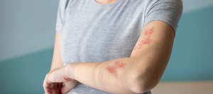 Minor Skin Infections Treatment Clinic Near Me in Bradenton, FL Minor Skin Infections Treatment Clinic Near Me in Bradenton, FL