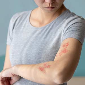 Minor Skin Infections Treatment in Bradenton, FL