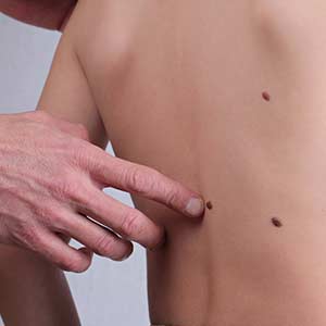 Skin Tag Removal in Bradenton, FL